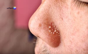 أفضل أنواع السيروم للبشرة الدهنية