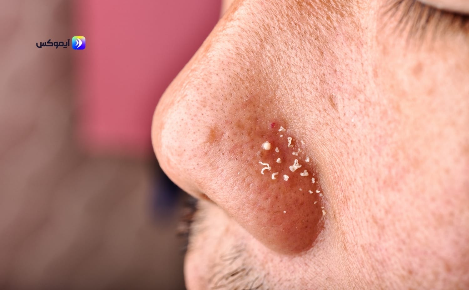 أفضل أنواع السيروم للبشرة الدهنية