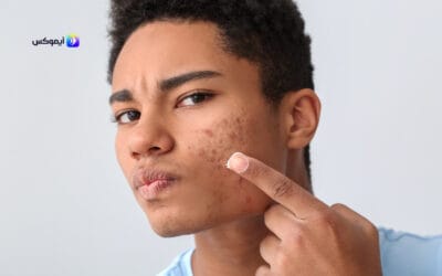 اقوى علاج لحب الشباب للبشره الدهنيه من تطبيق آيموكس