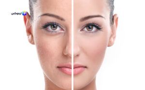 مقشر للبشرة الدهنية وحب الشباب طبيعي