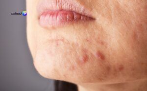 افضل كريم للحبوب للبشره الدهنيه