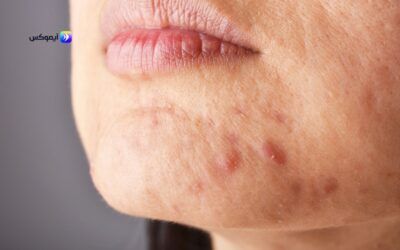 افضل كريم للحبوب للبشره الدهنيه من تطبيق آيموكس