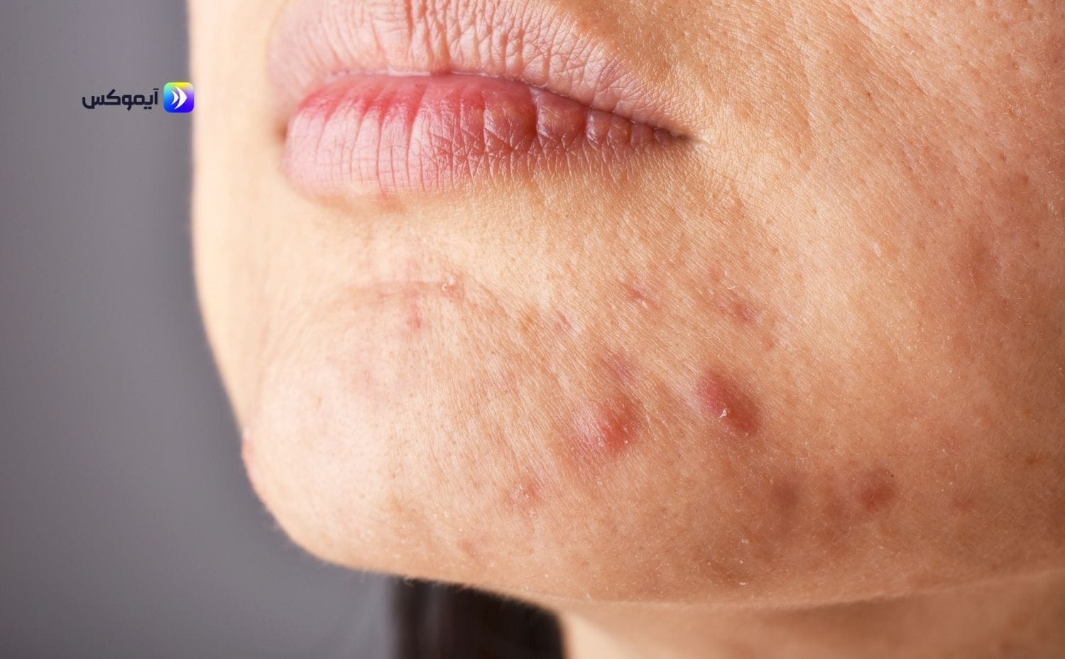 افضل كريم للحبوب للبشره الدهنيه