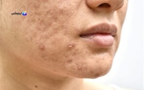 ماسك لنضارة البشرة الدهنية وتفتيحها