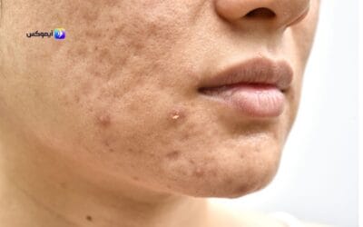 ماسك لنضارة البشرة الدهنية وتفتيحها من تطبيق آيموكس