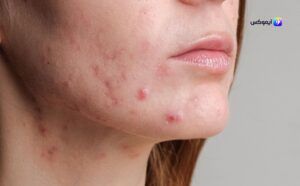 عيوب ومميزات البشرة المختلطة