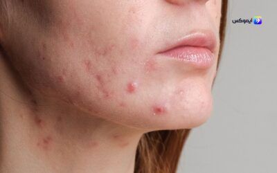 عيوب ومميزات البشرة المختلطة | دليل العناية وأفضل النصائح