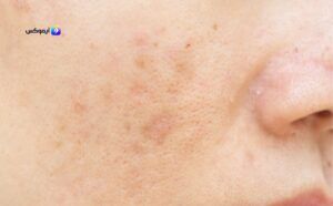 كيفية العناية بالبشرة الدهنية وتفتيحها