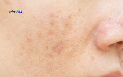 كيفية العناية بالبشرة الدهنية وتفتيحها – نصائح وخطوات فعالة