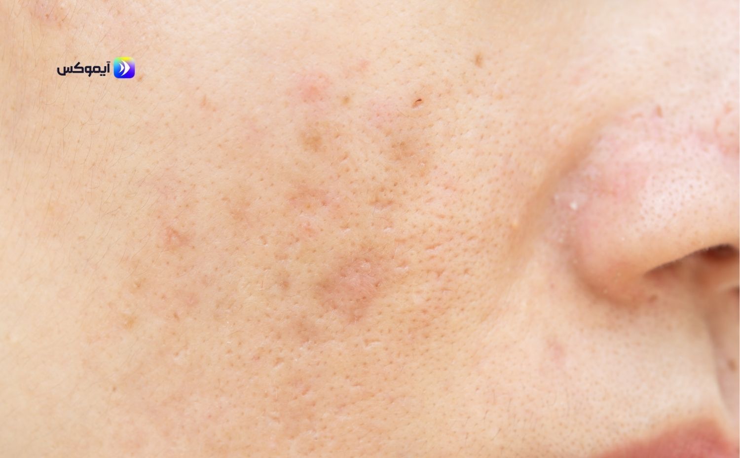 كيفية العناية بالبشرة الدهنية وتفتيحها كيفية العناية بالبشرة الدهنية وتفتيحها