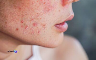سبب ظهور حبوب ذات رؤوس بيضاء في الوجه: الأسباب والعلاجات