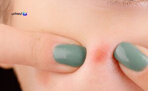 علاج ظهور حبوب في الوجه فجأة